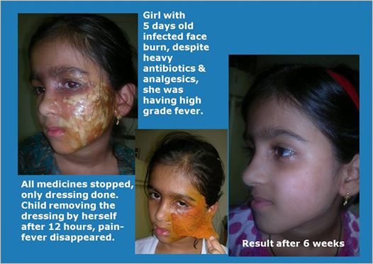Innovative Burn And Wound Care Of An Indian Surgeon Prevents Scars & Disabilities.